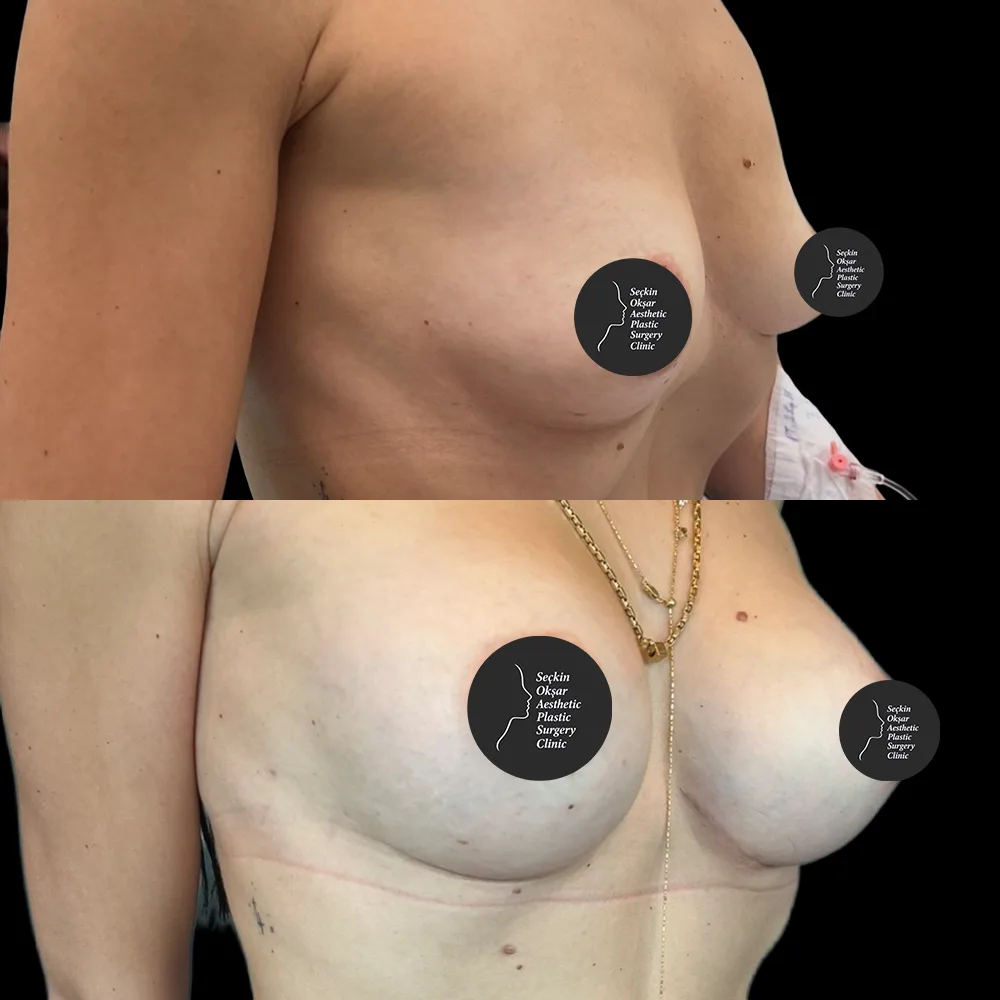 Breast augmentation, before and after, case 05, oblique view