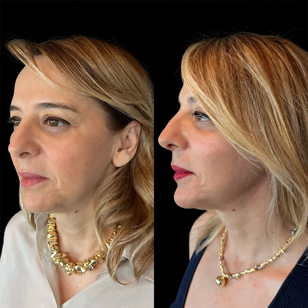 Face and neck lift, before and after, case 15, oblique view