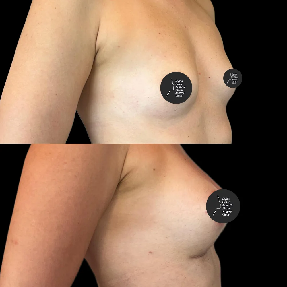 Breast augmentation, before and after, case 01, front view
