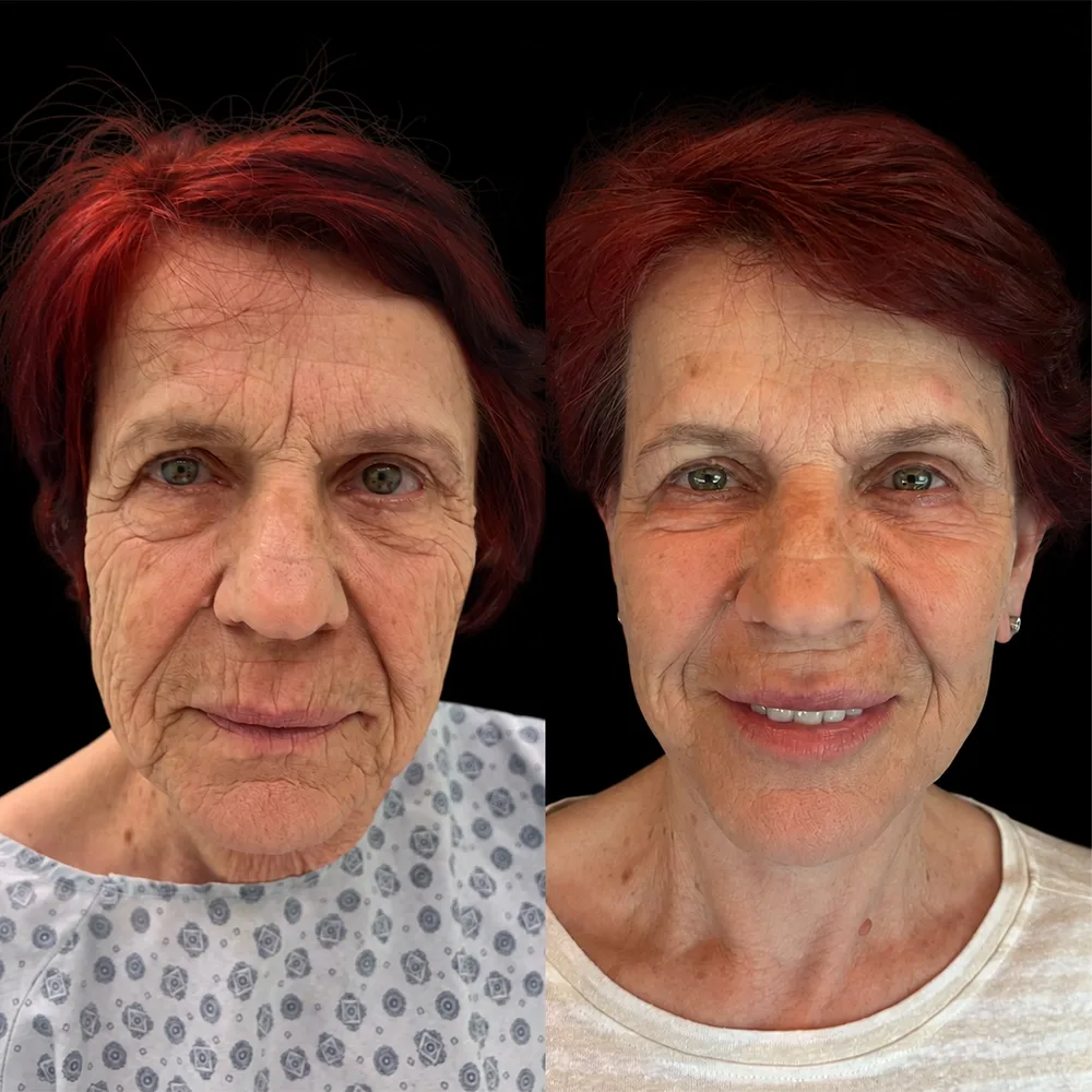 Face and neck lift, before and after, case 11, front view