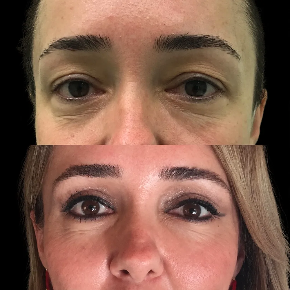 Eyelid surgery, before and after
