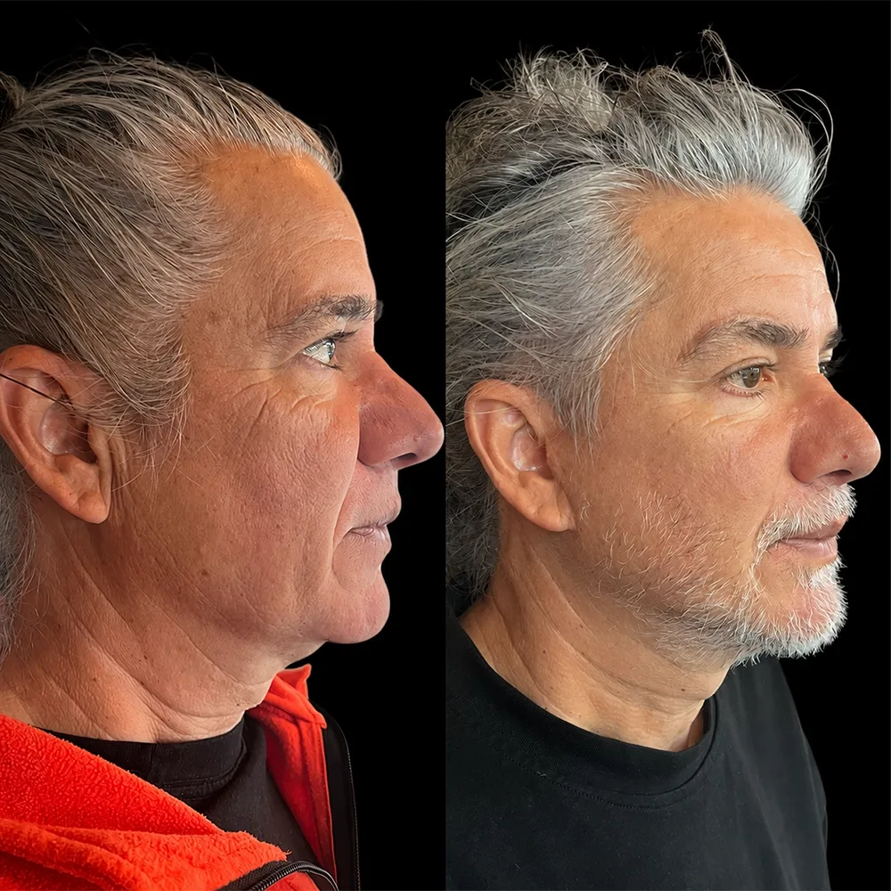 Face and neck lift, before and after, case 10, oblique view