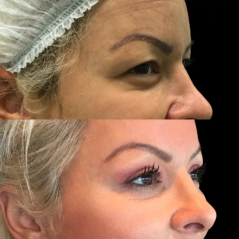 Eyelid surgery, before and after, case 02, oblique view