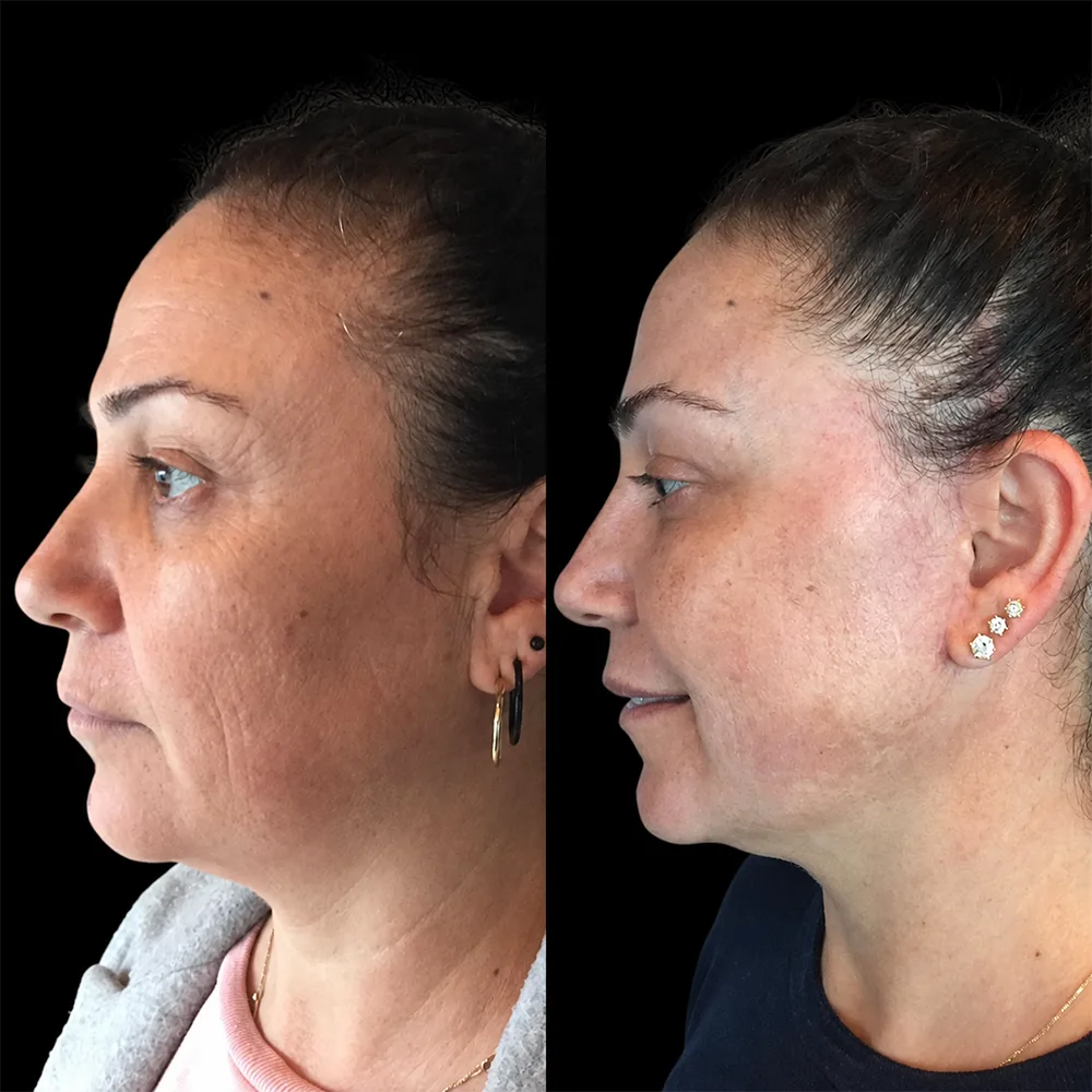 Face and neck lift, before and after, case 07, oblique view