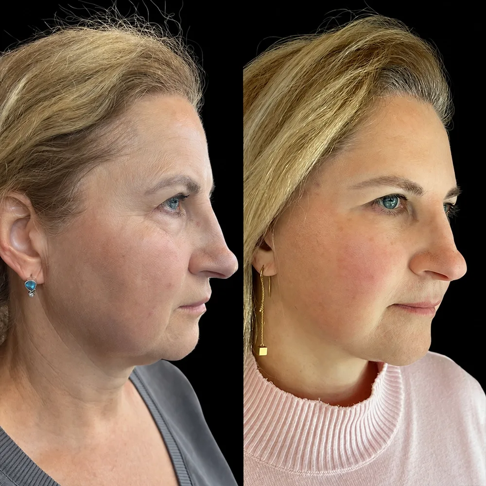 Face and neck lift, before and after, case 17, front view